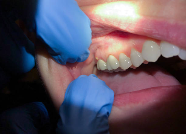 Best Lost Filling or Crown Replacement in Shiner, TX